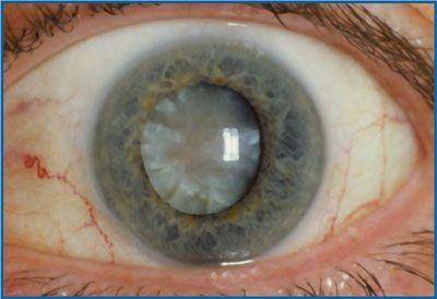 Katarakta je ozbiljno stanje oka koje može značajno uticati na kvalitetu života