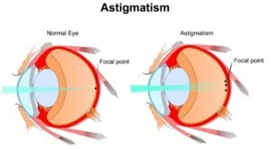 Astigmatizam – uzroci, simptomi i savremene metode liječenja
Što je astigmatizam?
Očna Klinika Dr.El-Halabi u Sarajevu na Ilidži