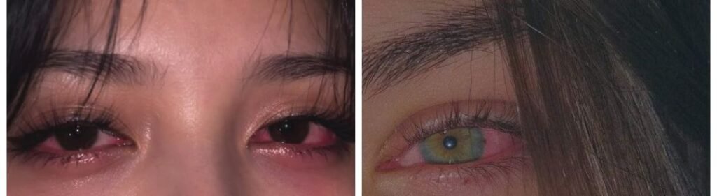 Konjunktivitis_simptomi_i_liječenje_Očna_klinika_Dr._El-Halabi_u_Sarajevu