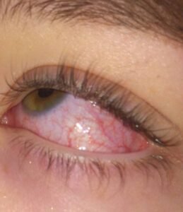 Crveno oko, dijagnostika-Conjunctivitis_dijagnostika_simptomi_i_liječenje._Očna_klinika_Dr._El-Halabi_na_Ilidži_u_Sarajevu