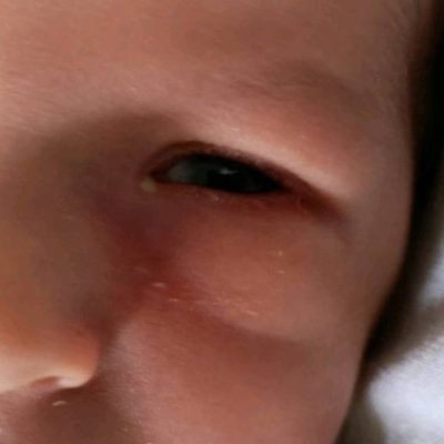 Začepljeni suzni kanal kod djece je češća pojava . liječenje u Klinici Dr.El-Halabi u Sarajevu na Ilidži
